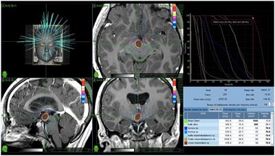 Image-guided LINAC radiosurgery in hypothalamic hamartomas